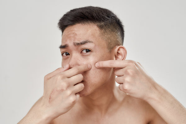 Troubleshooting Blackheads: What are they? And how can plant-derived ingredients help?